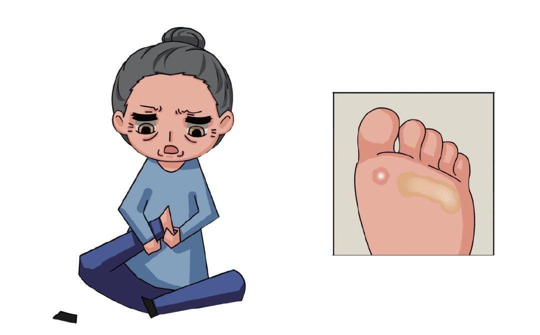 并发症|糖尿病足患者旅行，不能说走就走