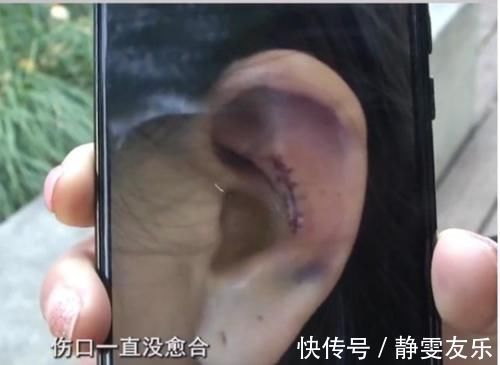 变形 隆鼻手术后耳朵变形,十多万索赔被拒,医院:没有特别失败