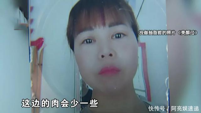 做完抽脂后，女子脸上多出两个鼓包，还因此失去两段“姻缘”