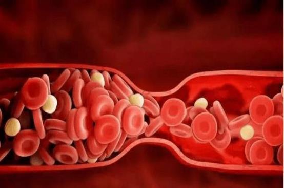 血管|高血脂“克星”公开,避免做这几件事,血管干净通畅