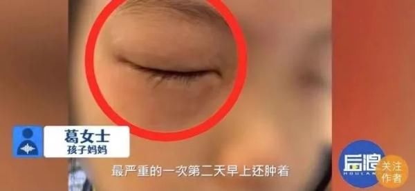 过敏|小姑娘一做数学题就眼睛过敏！学校家庭和数学，谁该背锅？