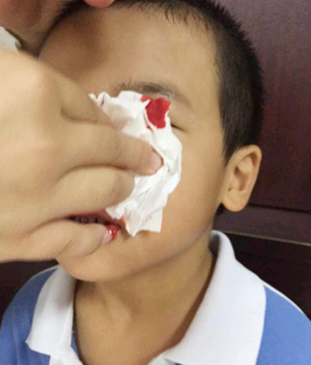 白血病|孩子出现三大“异常”,可能是患白血病的征兆,家长万不可忽略