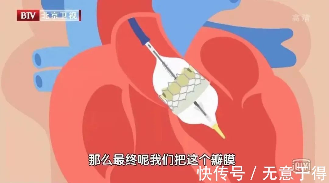 手术治疗|高血压“突然正常”,别急着高兴!很有可能是这种致命危机