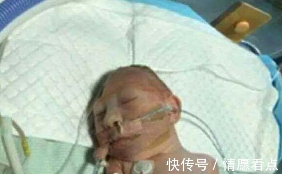 切除|刚来世的女婴切除大脑,医生放弃治疗,但妈妈的话却救了她一命