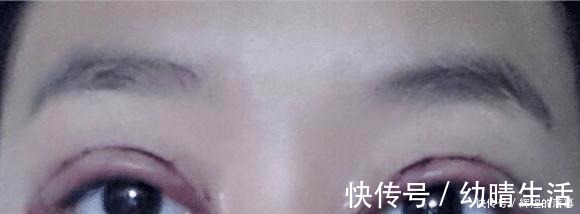 年轻人 做过双眼皮手术的年轻人,老了以后眼睛会怎么样看来是这个道理!