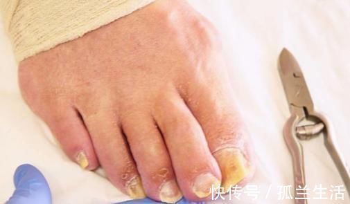 慢性疲劳|脚上老茧不用慌,1个小妙方,助你轻松解决!但4类人并不适宜!