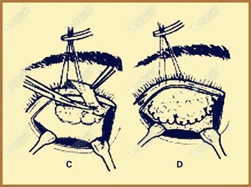 下垂|上眼皮下垂做额肌瓣悬吊术改善能管几年?术后会出现闭不上眼的情况吗