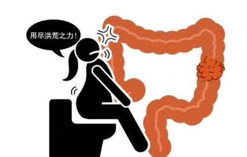 腹泻|直肠癌多半是拖出来的？4种异常迹象，暗示直肠已“亮红灯”