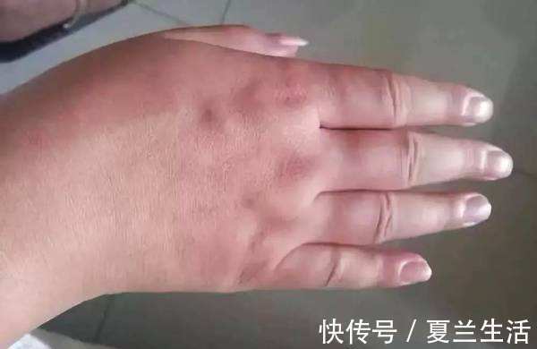 肝掌|肝好不好，全“写”在手上，手上若无3种“表现”，肝脏很健康