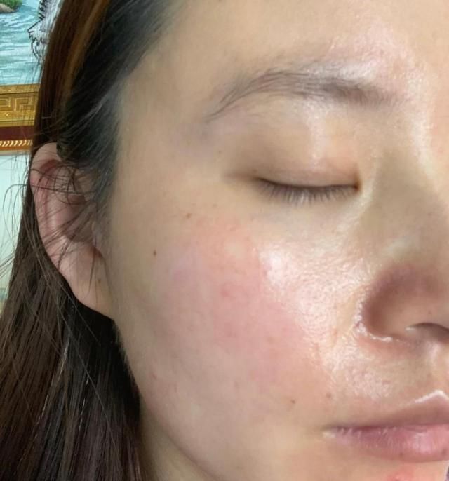 红血丝|判断你是不是“敏感肌”?看脸上这几个地方,很简单就能看出来!