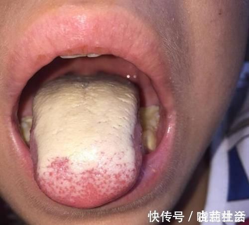 小儿脾虚|小儿脾虚“清洁工”公布,不是山楂,常吃带走积食不消化,脾胃好