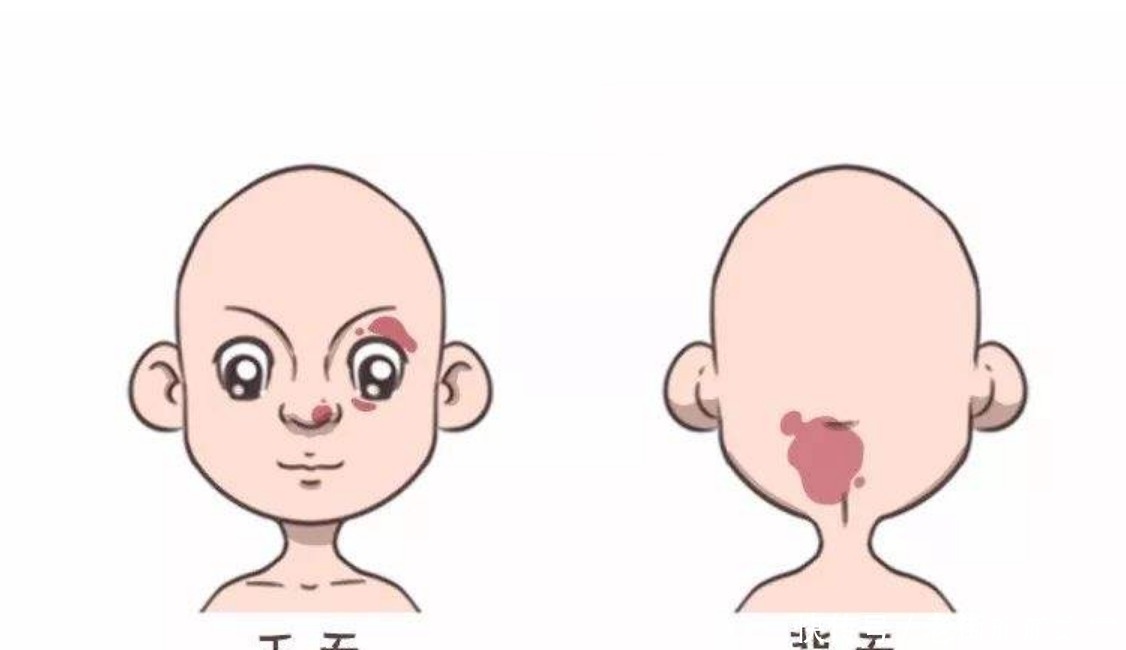 孕妈若有4个行为,胎儿脸上容易留胎记,别让宝宝长大自卑