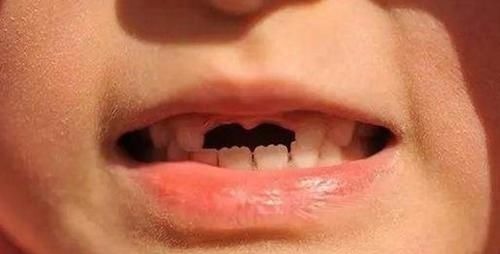 脱落|孩子“乳牙”脱落别着急扔,关键时刻能救命不懂为啥尽快了解下