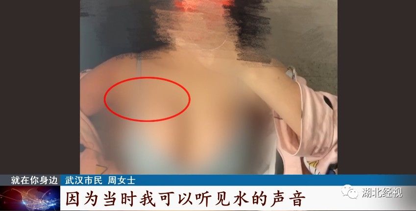 美兮医院|女子隆胸后假体移位：“胸长到肩膀下面了”！医美机构却这样说