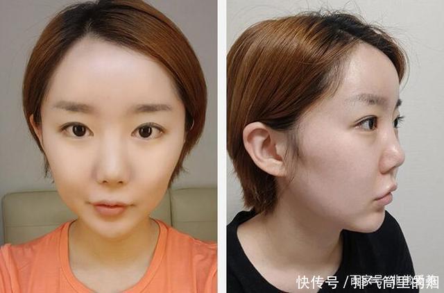 韩国妹子做眼鼻和脂肪填充,网友看到恢复照说侧颜秒杀金泰熙!
