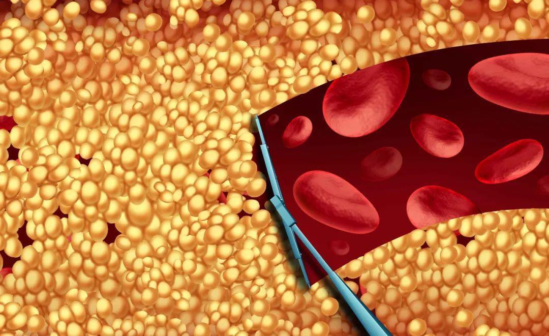 血管狭窄|颈动脉有斑块怎么办？做好3件事，让你远离斑块，呵护血管健康