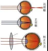 老花镜|我来告诉你！远视和老花是怎么回事