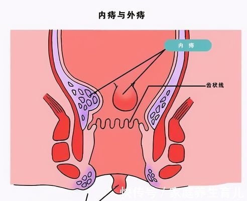 疗法|得了痔疮怎么办?老中医自用的“七分养三分治”疗法,快速消除痔疮肉球!