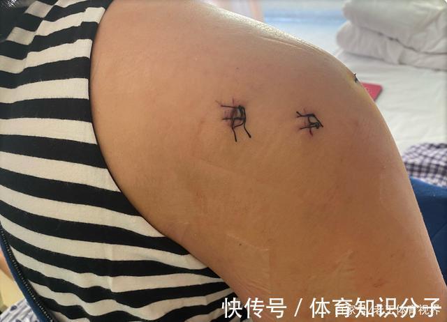 中国女排|8颗钉植入右肩,颜妮手术顺利报平安,她是中国女排永远的北长城