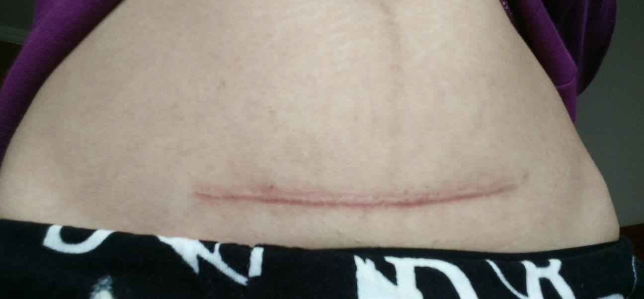 三胎|“横剖”与“竖剖”,哪个对二胎、三胎影响更大?这个选择很重要