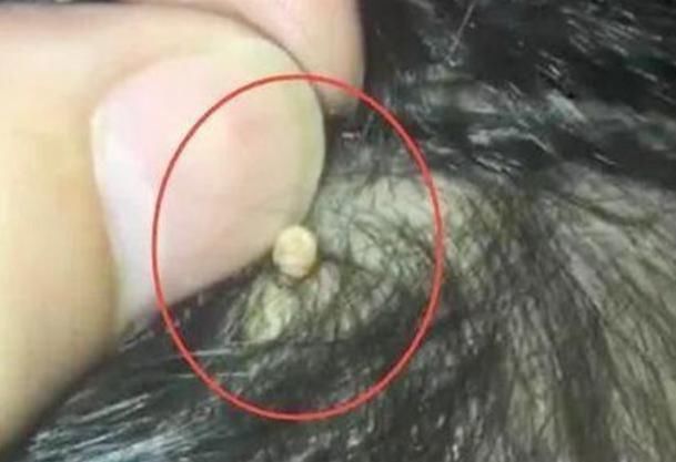 孩子|爸爸给女儿梳头看见“小米粒”,急忙送医检查,医生还好来得早