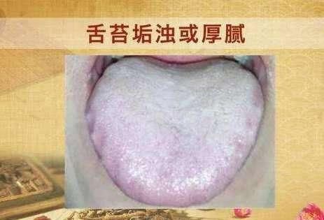 痰湿|一个非常强大的方子，只需3味药，把痰湿彻底根除，神清气爽