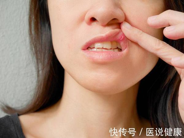 槟榔素|女子连续口腔溃疡一个月,为何最终查出舌癌?这6类人可得当心