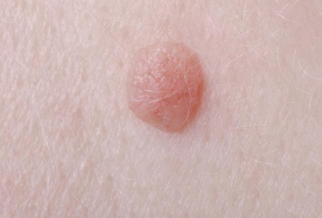 hpv|雙腿或是宮頸癌敲的“警鐘”，如出現以下3個異常，要及時查HPV