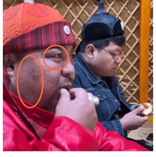 恩克近況堪憂，臉上浮現“黑斑”、痘痘，做青菜招待客人