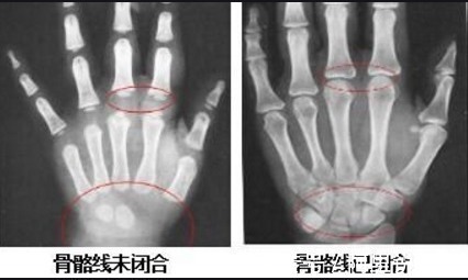 骨骼|男孩长高有2个“黄金期”,骨骼线闭合前都有机会,别放弃太早