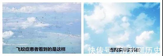 眼球|近视的眼球如同一个吹大的气球，近视度数越高，气球越大，越危险