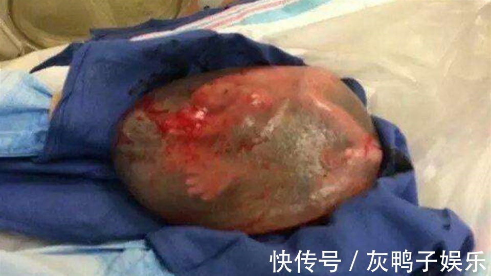 医生|生下“带壳宝宝”,产妇着急落泪,医生却高兴祝贺是好事