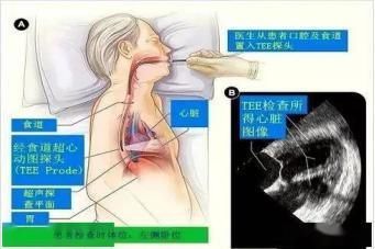 给心脏做个彩超，却要经食道来检查是怎么回事？