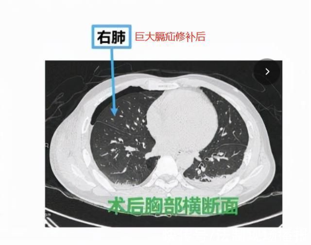 膈疝|肠子挤到了肺旁边?男子健身后身体变差,医生:创伤性膈疝