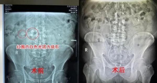 剧痛|男子偏爱喝浓茶，因此进了医院…