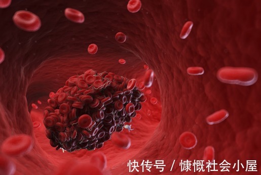 医生|高血脂的祸根是“它”吃一口等于吃8口油，医生：降脂用四个方法