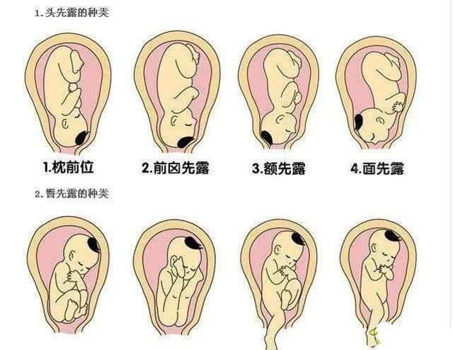 顺产|顺产or剖腹那个好？这8个特殊情况，产妇只能剖腹产