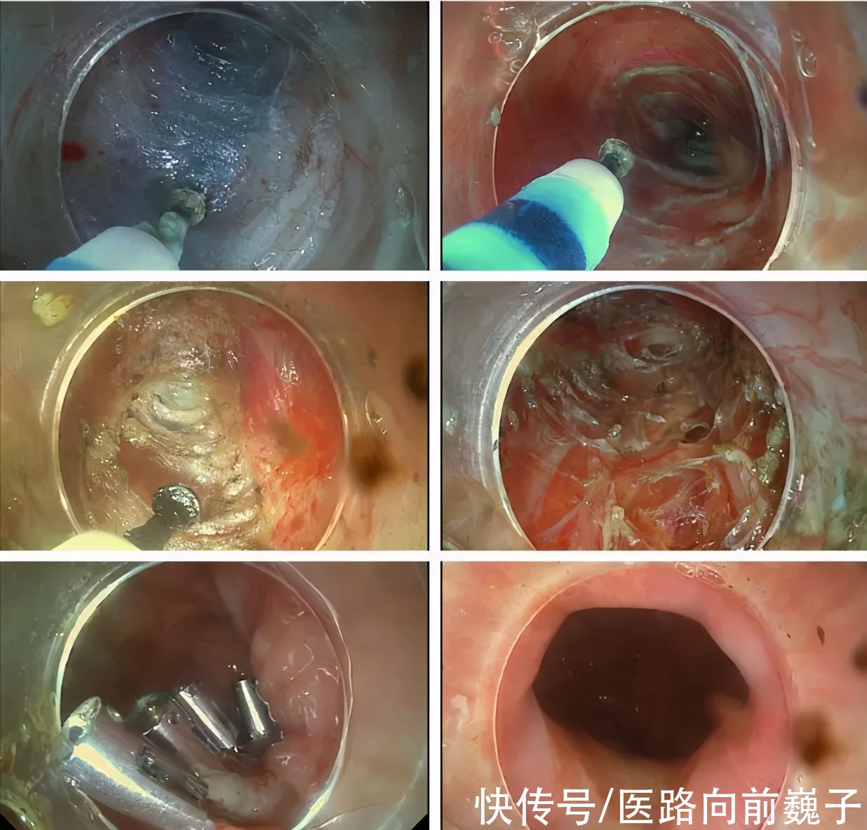 食管|吞咽困难，吃啥吐啥，还胸痛，胃镜也没事，这是得了什么病？