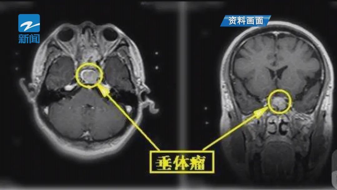 浙大一院|小伙一年长高35厘米！医生提醒：这些日常变化要注意