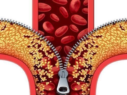 血管|有1种叶子晒干煮水喝，把甘油三酯“冲走”，血管也通畅干净