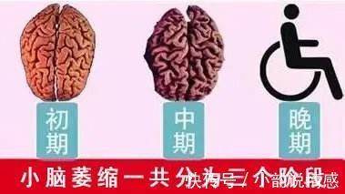 蔡女士|老年人小脑萎缩是怎么回事?