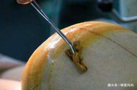 肚子|产妇刚生完娃,肚子仍“鼓的”像怀孕8个月,医生手术后对不起