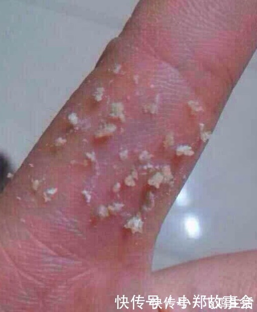 水乳|先别慌着挤黑头,这3种原因你知道了再挤也不迟