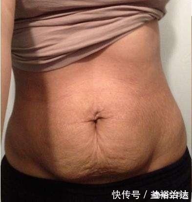 侧切|顺产时怎么做能避免撕裂和侧切?产后如何甩掉大肚子?