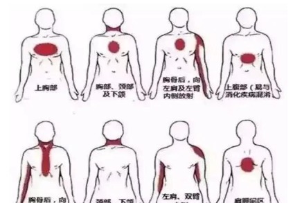 生气|50岁女性,前胸后背疼痛3个月,怎么判断是生气造成,还是冠心病