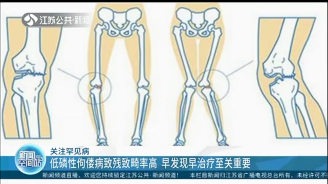 张爱华|关注罕见病：低磷性佝偻病致残致畸率高 早发现早治疗至关重要