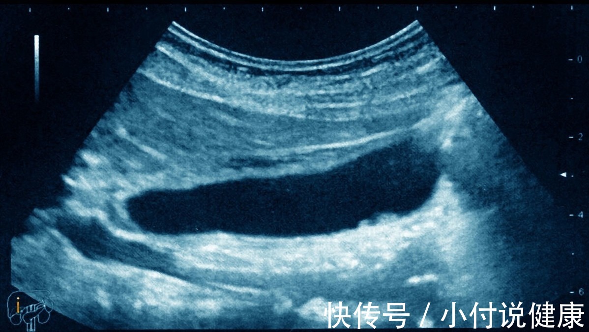 结石|别再把消化不良当胃病!或许是胆囊不好了,听听医生怎么说
