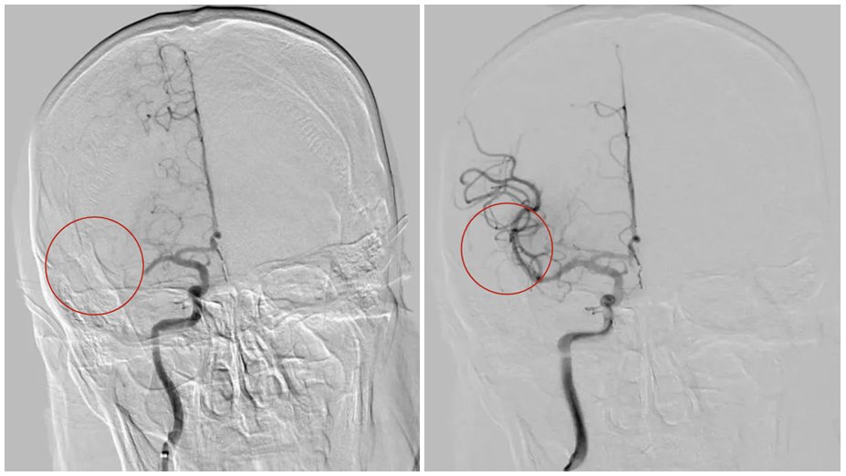 A citizen in Suzhou suffered a stroke, and doctors seized the 