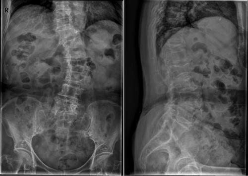椎体|脊柱常见肿瘤及肿瘤样病变的几种影像学表现,你都见过吗?