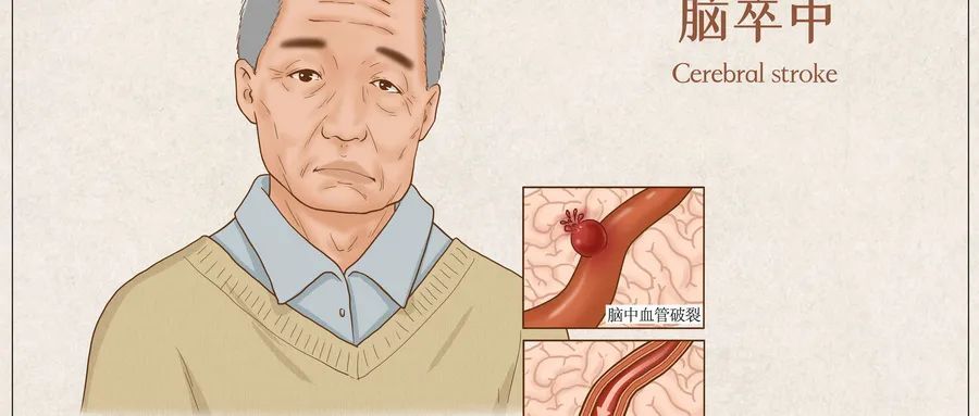 一生|一生不中风的方法，对中老年人太重要！不用吃药，简单实用